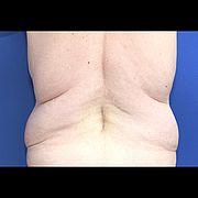 Bauchdeckenstraffung, 59 Vorher Nachher