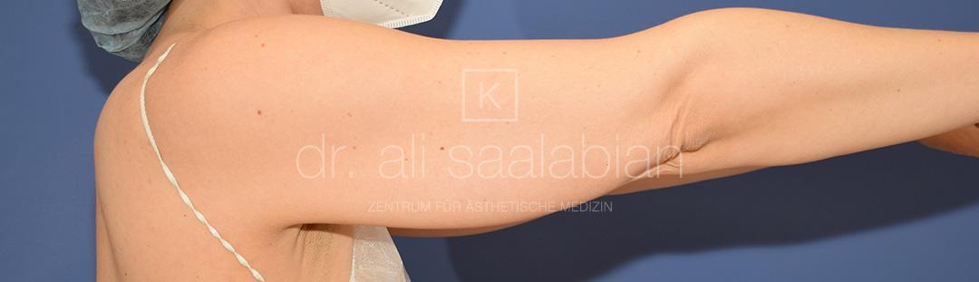 Fettabsaugung, 43 Vorher Nachher