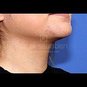 Fettabsaugung, 29 Vorher Nachher