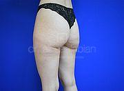 Fettabsaugung, 29 Vorher Nachher