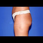 Fettabsaugung, 43 Vorher Nachher