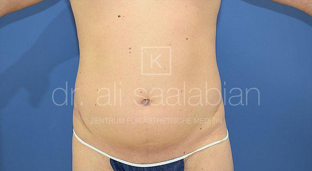 Fettabsaugung, 40 Vorher Nachher