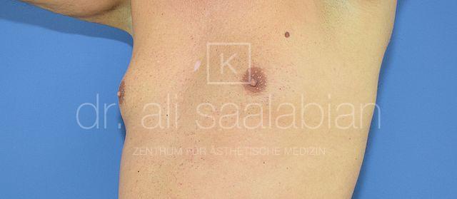Fettabsaugung, 37 Vorher Nachher
