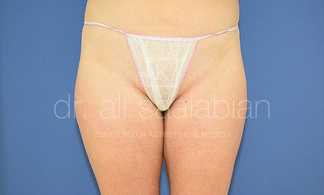 Fettabsaugung, 26 Vorher Nachher