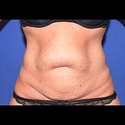 Bauchdeckenstraffung, 39 Vorher Nachher
