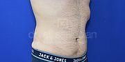 Fettabsaugung, 32 Vorher Nachher