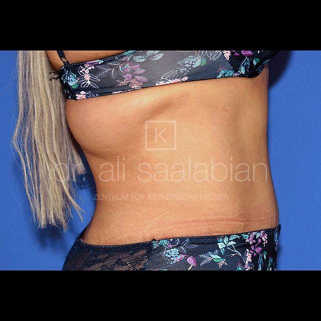 Bauchdeckenstraffung, 43 Vorher Nachher