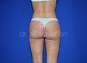 Fettabsaugung, 29 Vorher Nachher