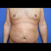Fettabsaugung, 42 Vorher Nachher