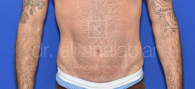 Fettabsaugung, 37 Vorher Nachher