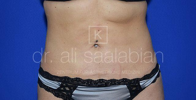 Fettabsaugung, 26 Vorher Nachher