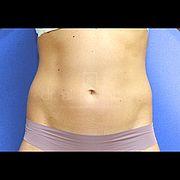 Fettabsaugung, 31 Vorher Nachher