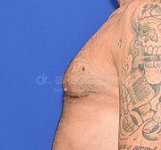 Fettabsaugung, 37 Vorher Nachher