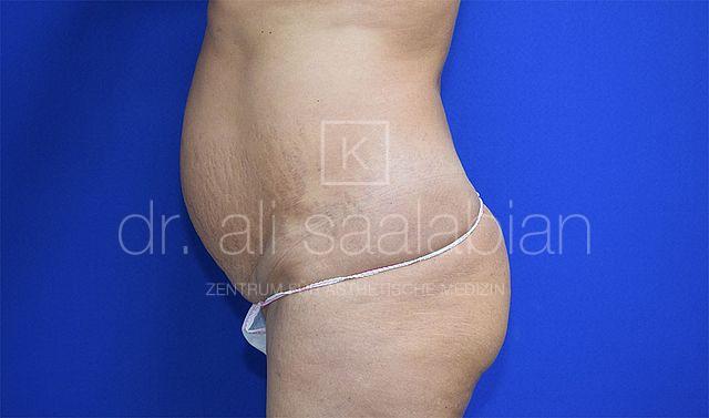 Bauchdeckenstraffung, 52 Vorher Nachher