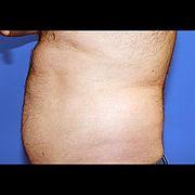 Fettabsaugung, 48 Vorher Nachher