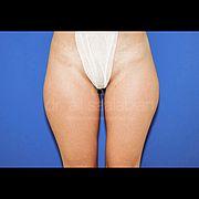 Fettabsaugung, 29 Vorher Nachher