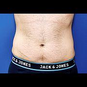 Fettabsaugung, 32 Vorher Nachher