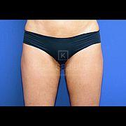 Fettabsaugung, 42 Vorher Nachher