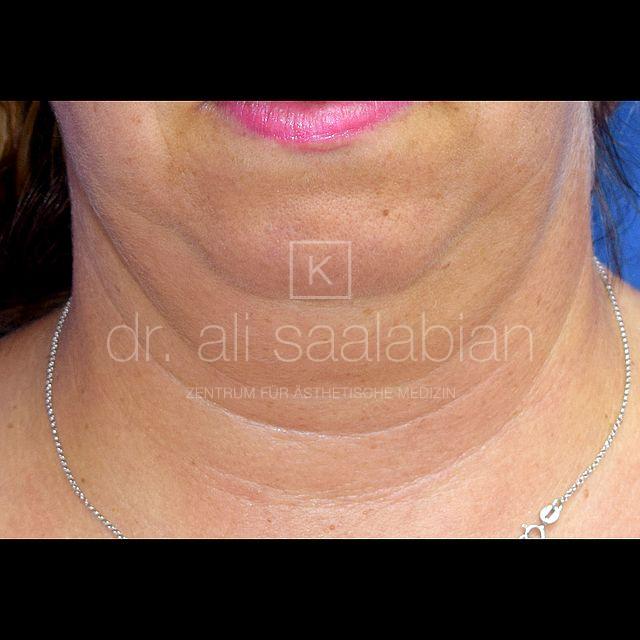 Fettabsaugung, 46 Vorher Nachher