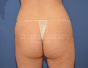 Fettabsaugung, 23 Vorher Nachher