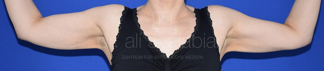 Fettabsaugung, 43 Vorher Nachher