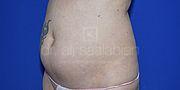 Fettabsaugung, 54 Vorher Nachher