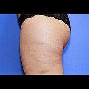 Fettabsaugung, 32 Vorher Nachher