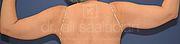 Fettabsaugung, 43 Vorher Nachher