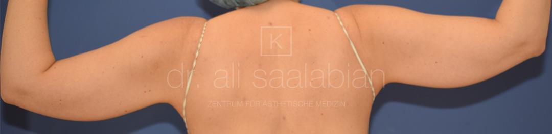 Fettabsaugung, 43 Vorher Nachher