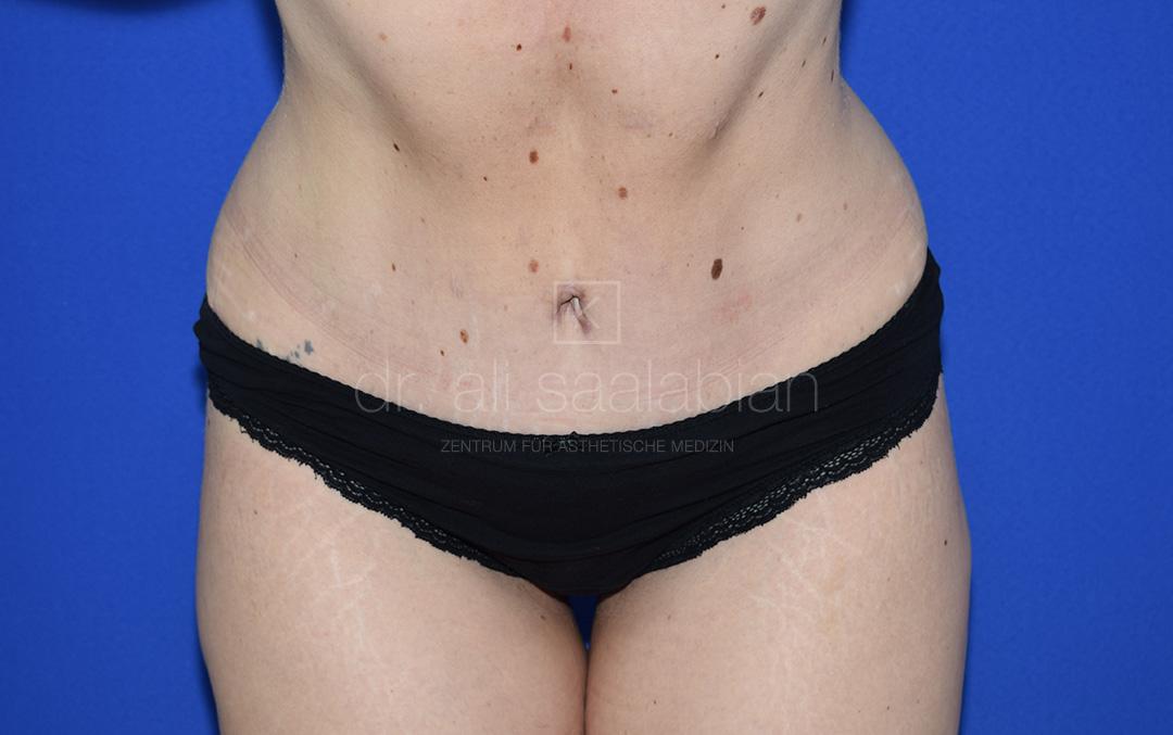 Bauchdeckenstraffung, 33 Vorher Nachher