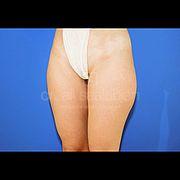 Fettabsaugung, 29 Vorher Nachher