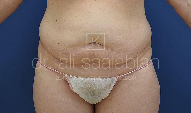 Fettabsaugung, 41 Vorher Nachher