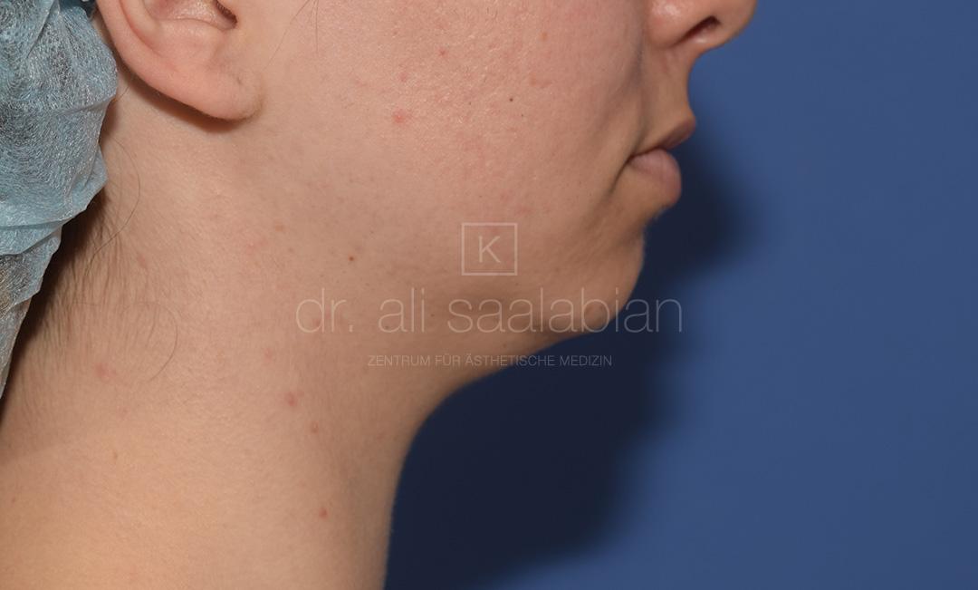 Fettabsaugung, 23 Vorher Nachher