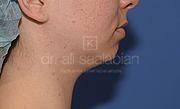 Fettabsaugung, 23 Vorher Nachher