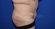 Bauchdeckenstraffung, 62 Vorher Nachher