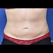 Fettabsaugung, 28 Vorher Nachher