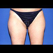 Fettabsaugung, 34 Vorher Nachher