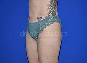 Fettabsaugung, 50 Vorher Nachher