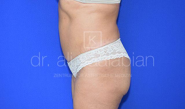 Bauchdeckenstraffung, 52 Vorher Nachher