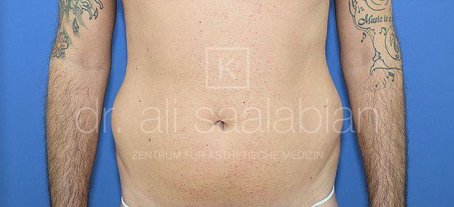 Fettabsaugung, 37 Vorher Nachher