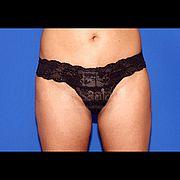 Fettabsaugung, 43 Vorher Nachher