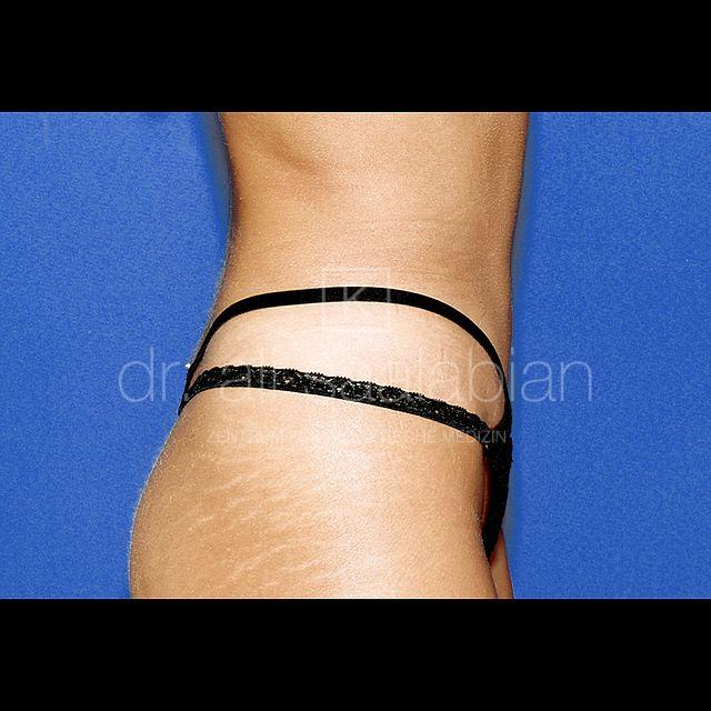 Fettabsaugung, 203 Vorher Nachher