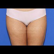 Fettabsaugung, 31 Vorher Nachher