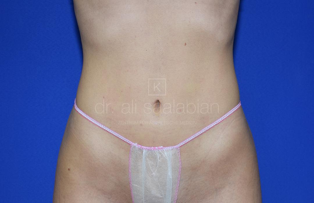 Fettabsaugung, 23 Vorher Nachher