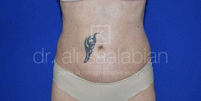 Fettabsaugung, 54 Vorher Nachher