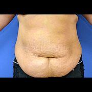 Bauchdeckenstraffung, 43 Vorher Nachher