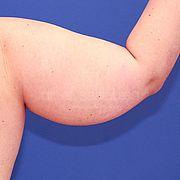 Fettabsaugung, 34 Vorher Nachher