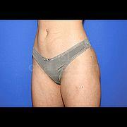 Body Contouring, 20 Vorher Nachher