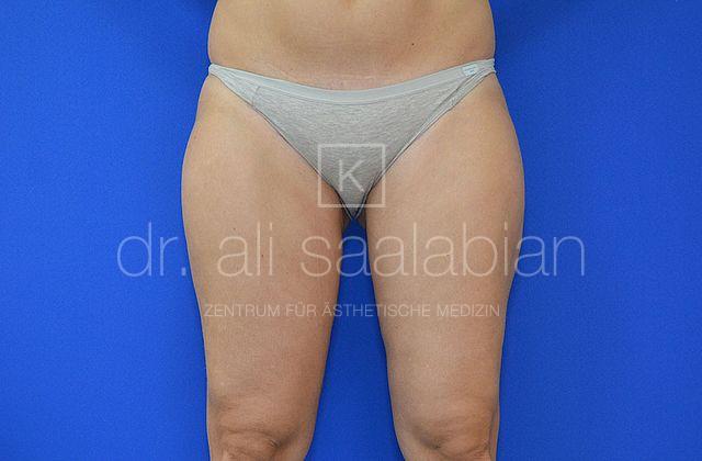 Fettabsaugung, 42 Vorher Nachher
