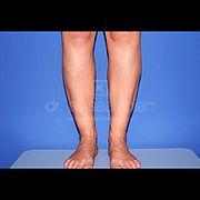 Fettabsaugung, 37 Vorher Nachher